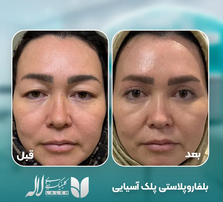 بلفاروپلاستی پلک آسیایی