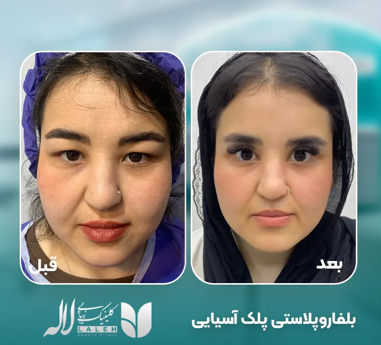 بلفاروپلاستی پلک آسیایی