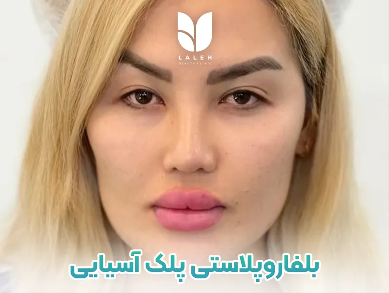 بلفاروپلاستی پلک آسیایی