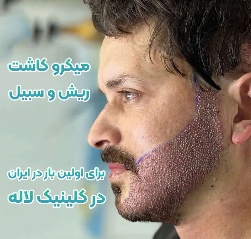 کاشت ریش و سبیل کلینیک لاله تهران