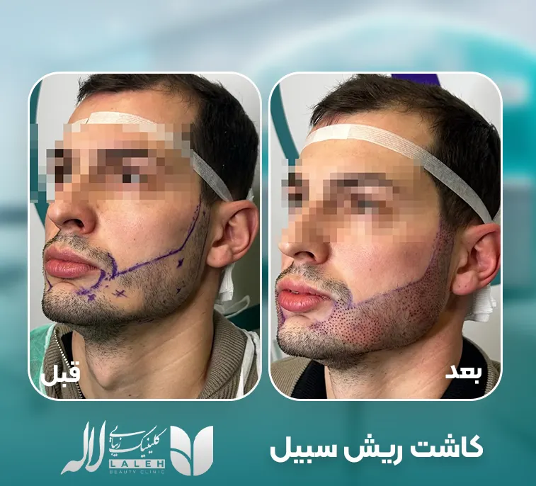 کاشت ریش ترمیمی