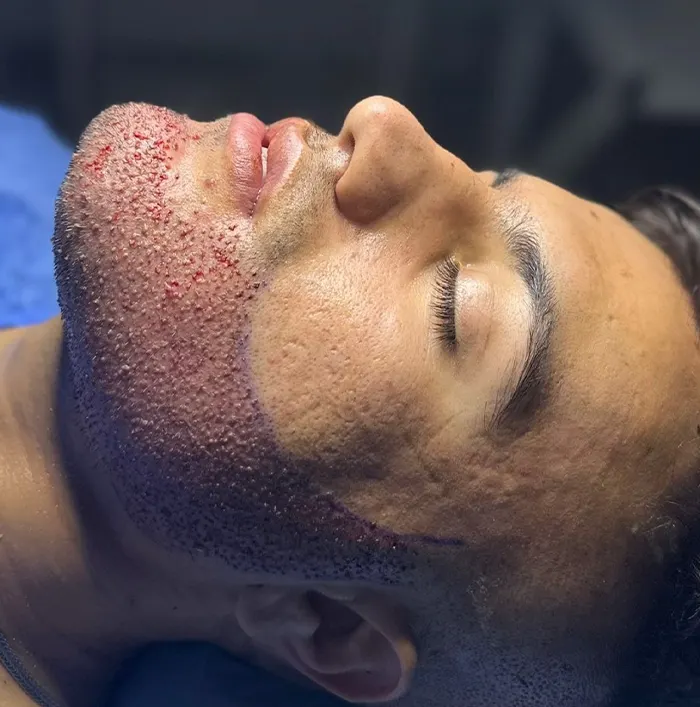 عوارض کاشت ریش و سبیل