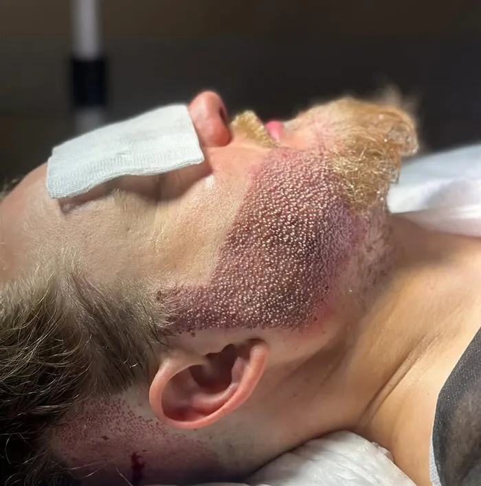 کاشت ریش و سبیل