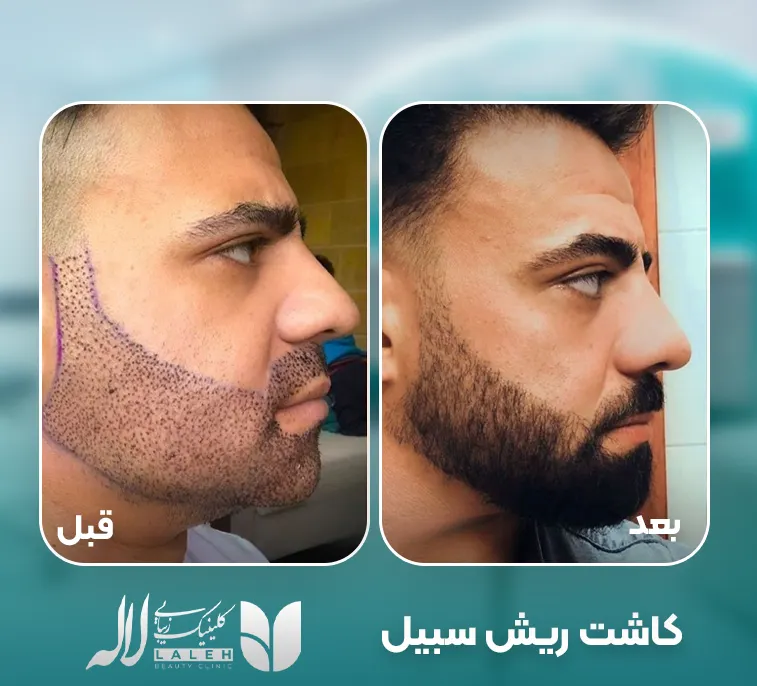 کاشت ریش و سبیل