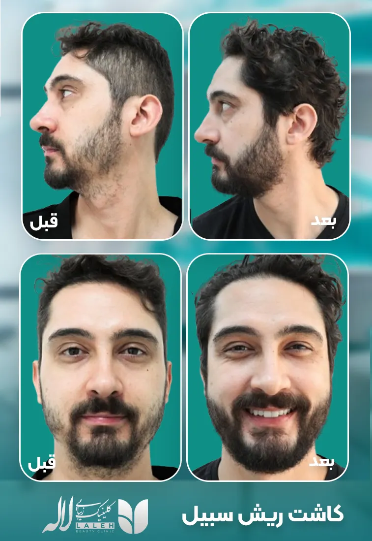 قبل و بعد کاشت ریش