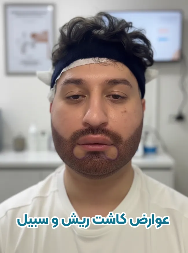 عوارض کاشت ریش و سبیل