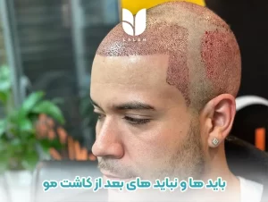 باید ها و نباید های بعد از کاشت مو