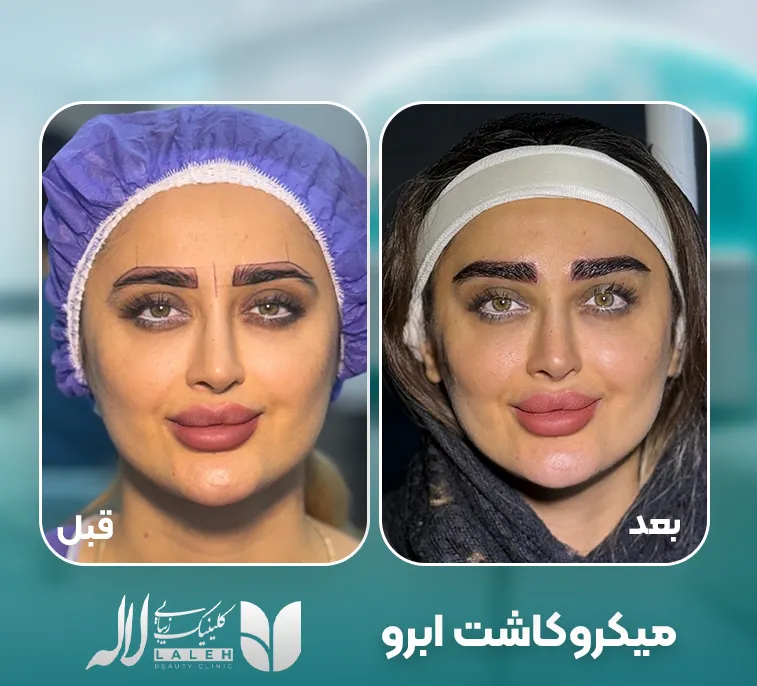 میکروکاشت ابرو