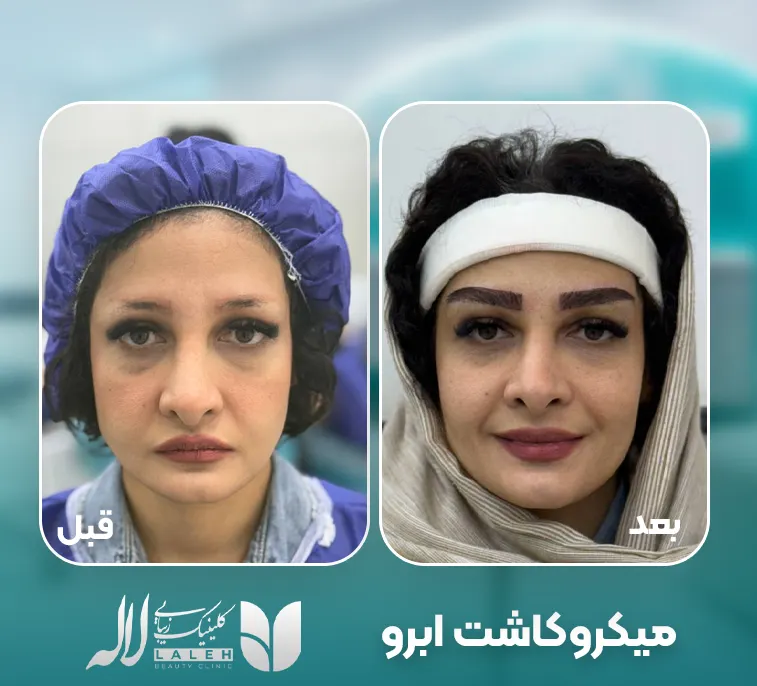 نحوه کاشت به روش میکروکاشت