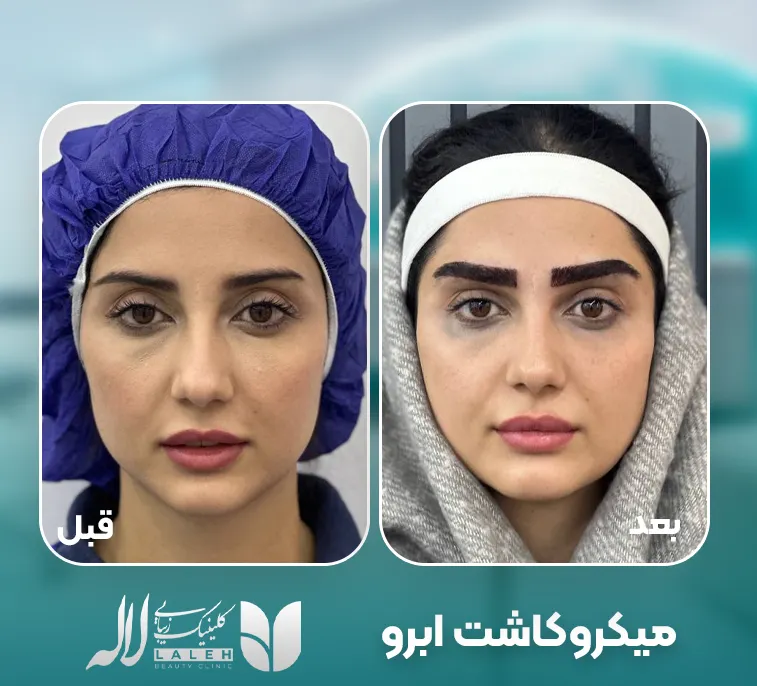 میکروکاشت لاله