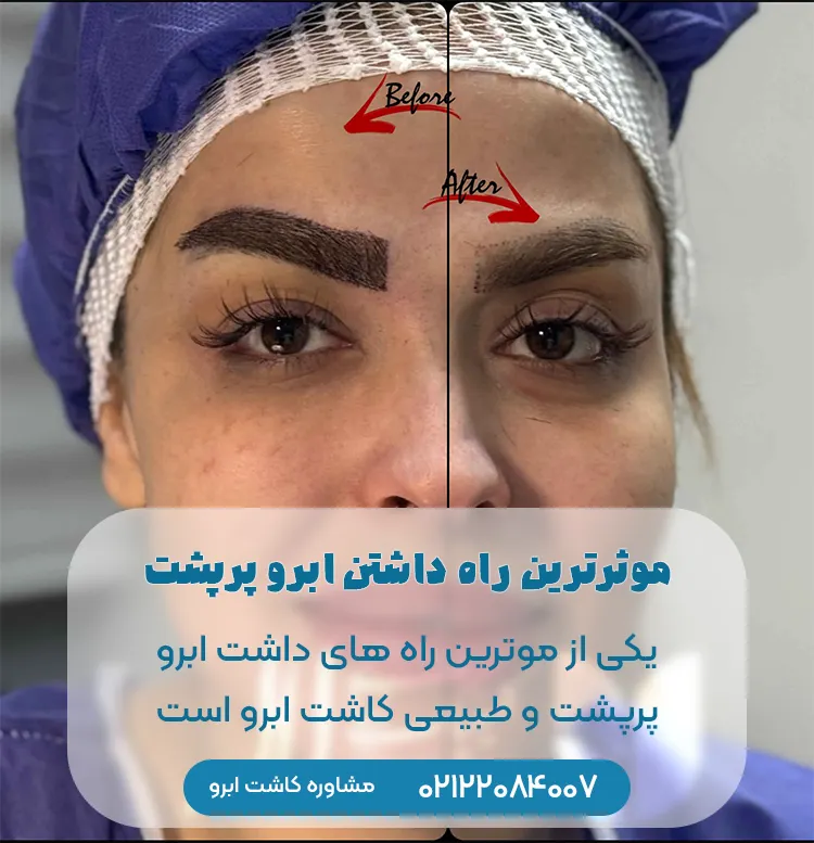 تقویت ابرو با کاشت ابرو