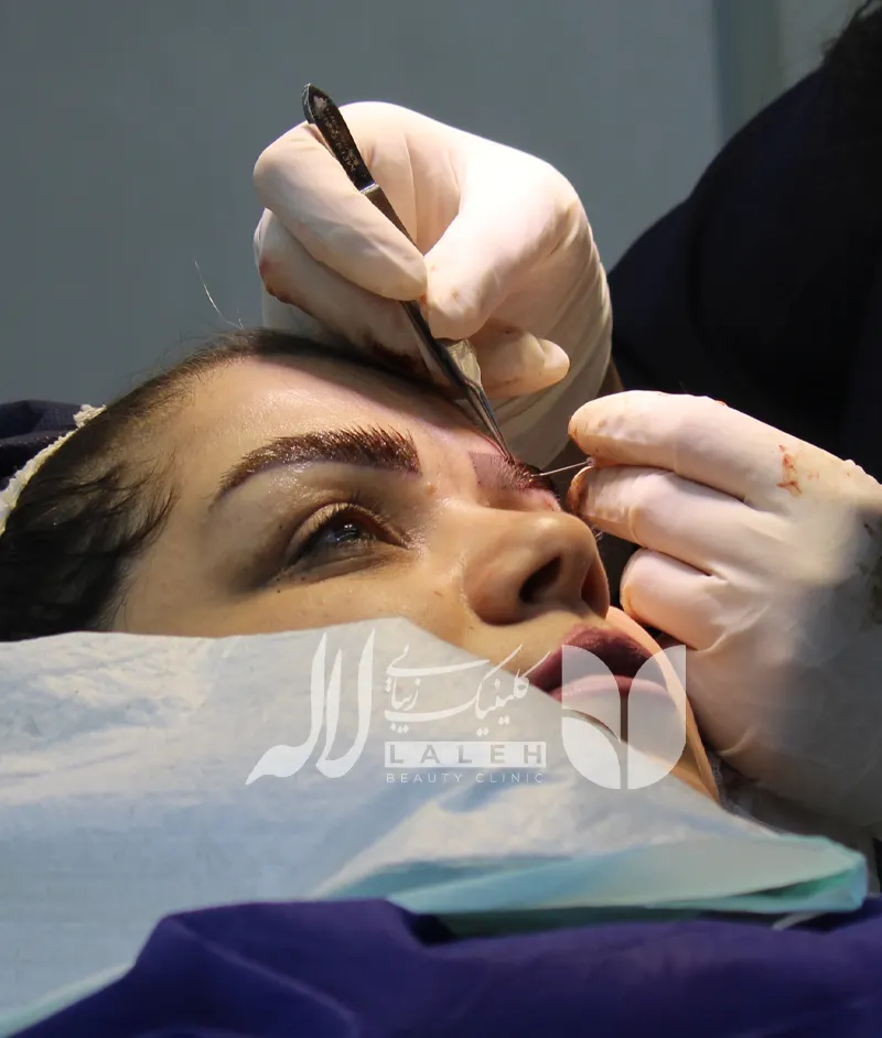 کاشت ابرو