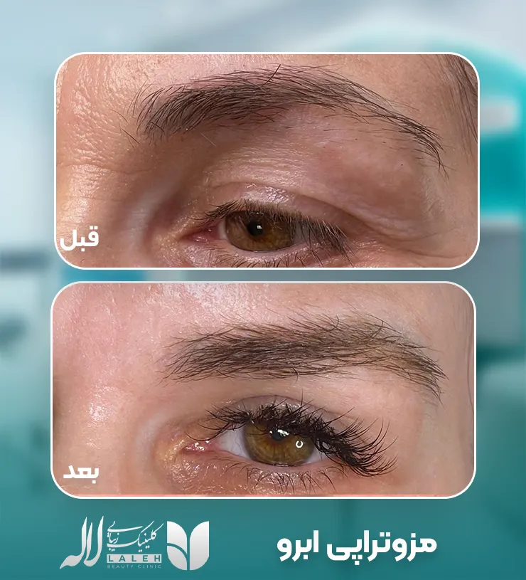 مزوتراپی ابرو
