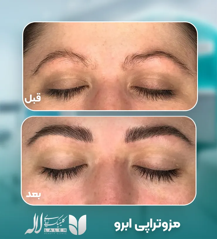 قبل و بعد مزوتراپی ابرو