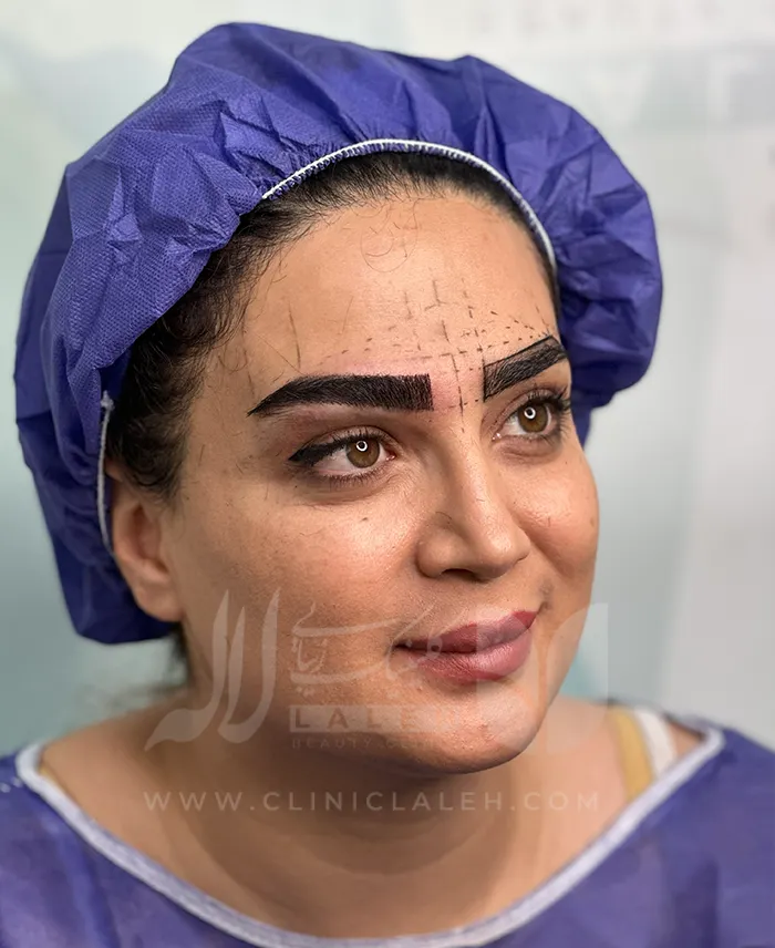 کاشت ابرو با موی فر