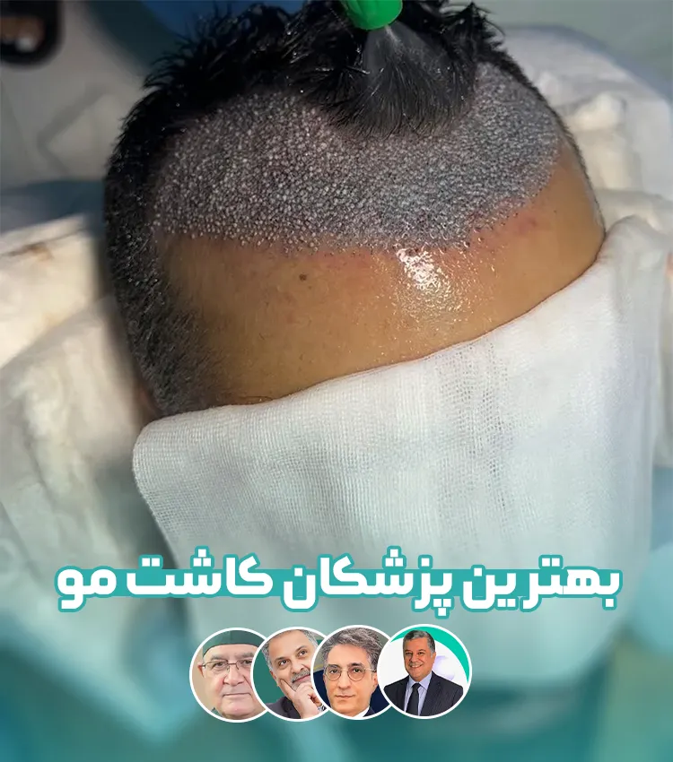بهترین پزشکان کاشت مو در تهران