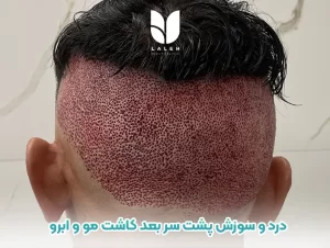 دلیل درد و سوزش پشت سر بعد کاشت مو و ابرو