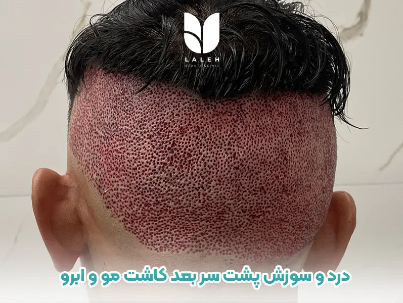 دلیل درد و سوزش پشت سر بعد کاشت مو و ابرو