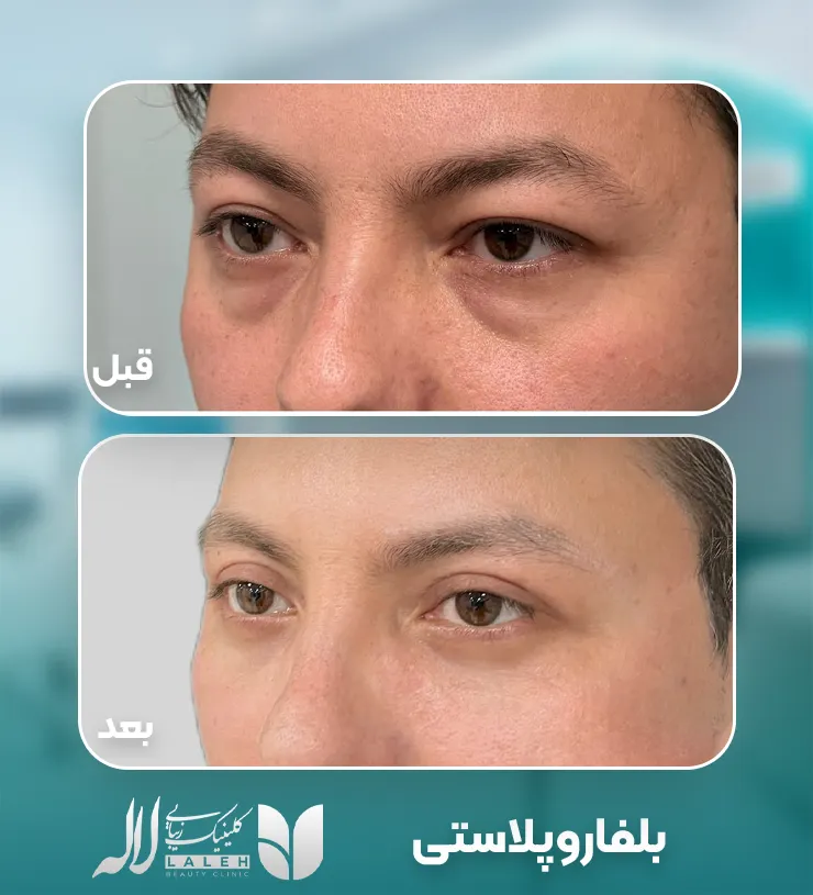 بلفاروپلاستی پلک پایین