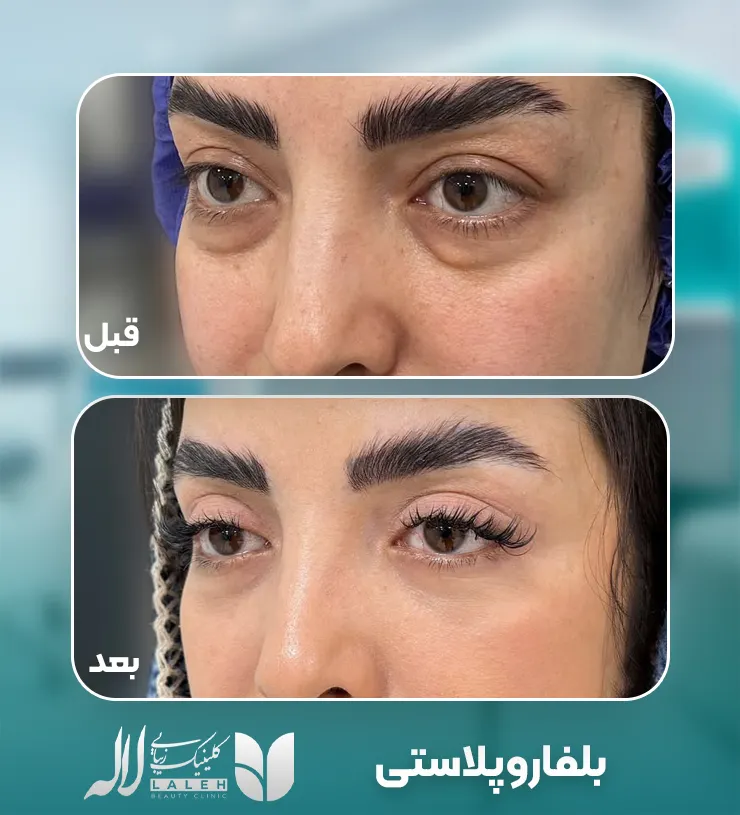 بلفاروپلاستی پلک بالا و پایین