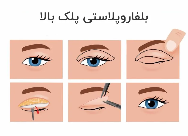 بلفاروپلاستی پلک پایین