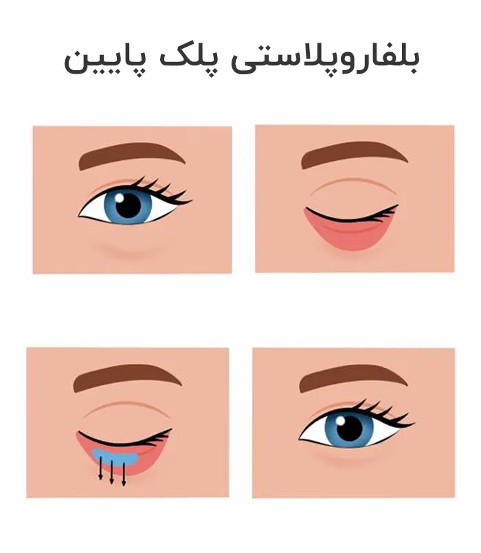 بلفاروپلاستی پلک پایین