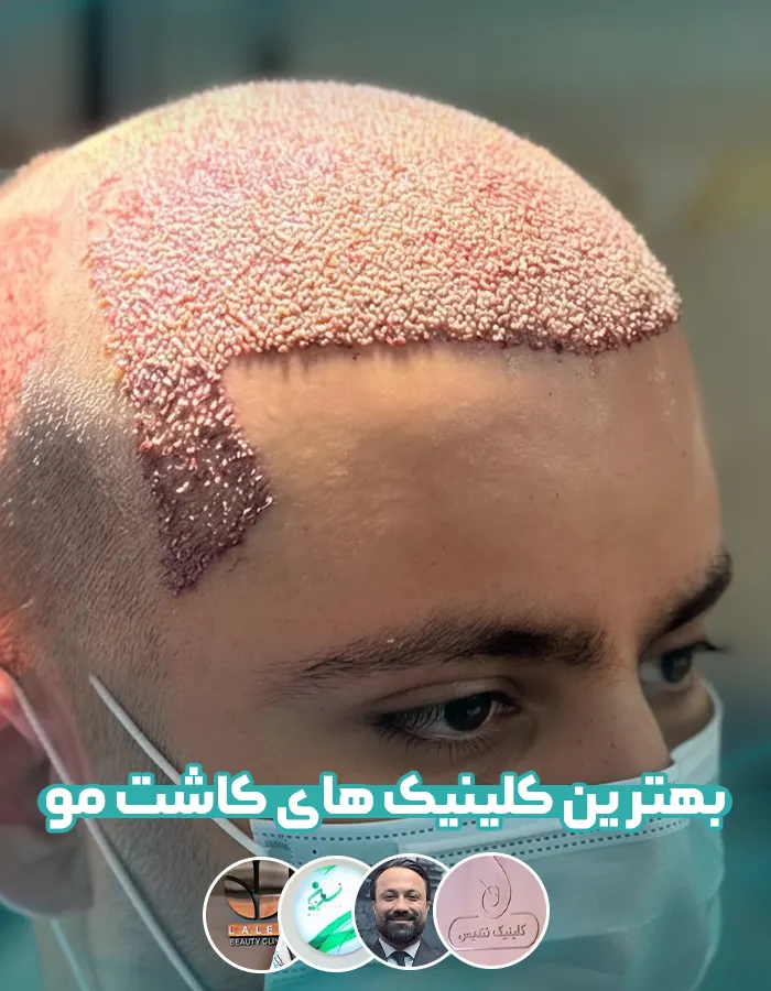 بهترین کلینیک کاشت مو تهران