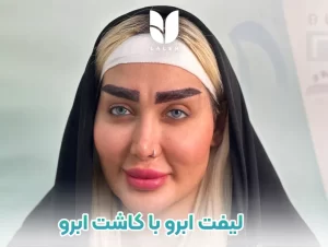 لیفت ابرو با کاشت ابرو