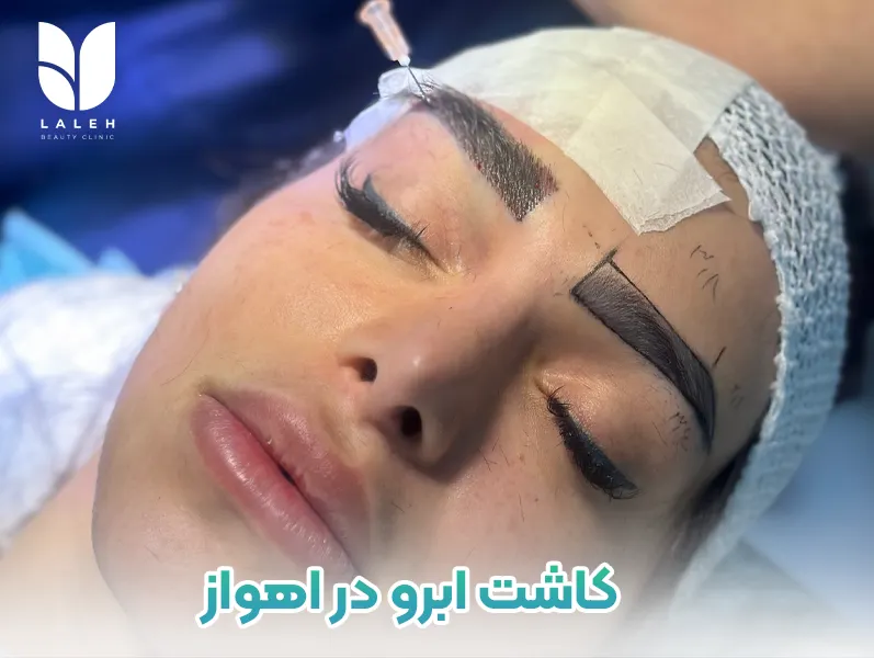 کاشت ابرو در اهواز