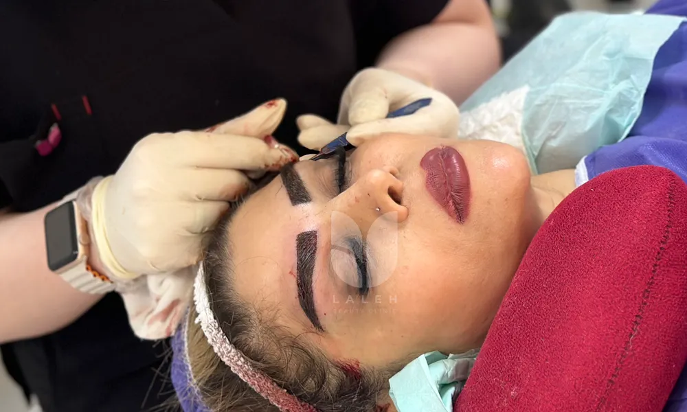 کاشت ابرو در کرماشاه