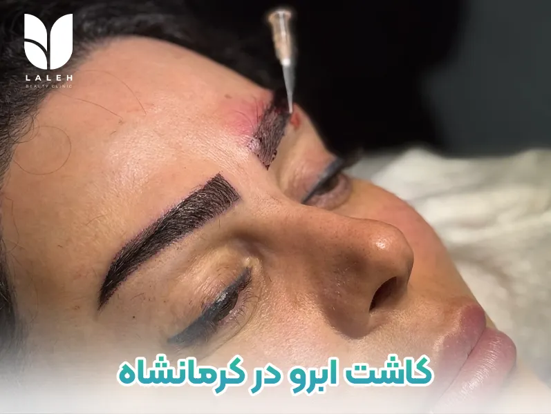 کاشت ابرو در کرماشاه