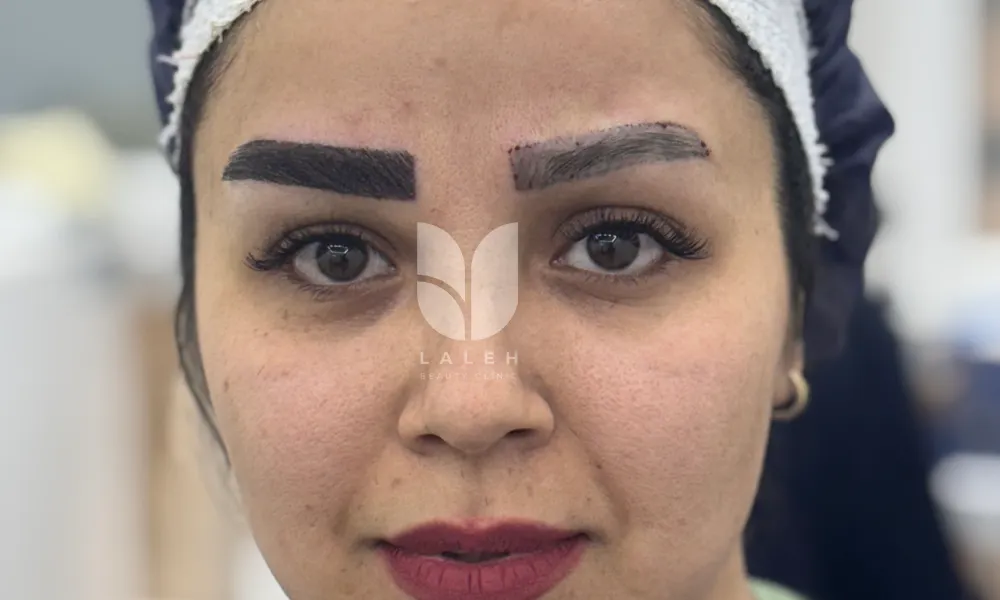 کاشت ابرو در مشهد