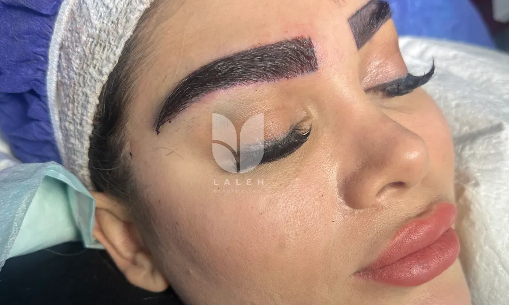 کاشت ابرو مازندران