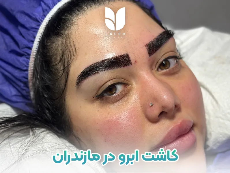 کاشت ابرو مازندران