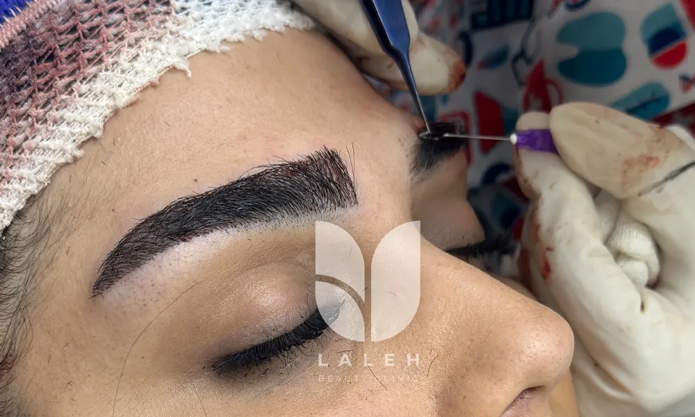 کاشت ابرو در قزوین