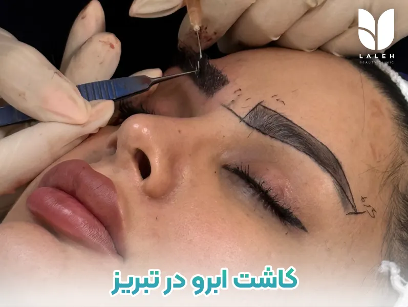 کاشت ابرو تبریز