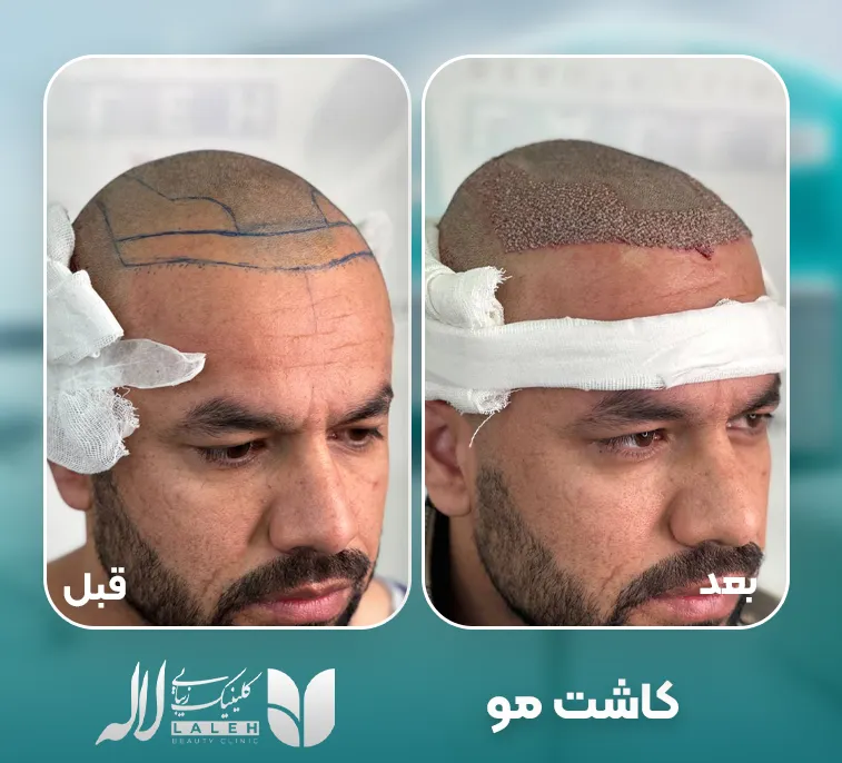کاشت مو