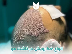 انواع خط رویش مردانه در کاشت مو