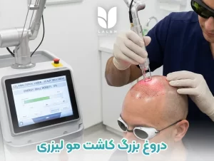 کلاهبرداری و دروغ با کاشت مو لیزری