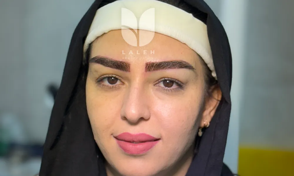 کاشت ابرو تبریز