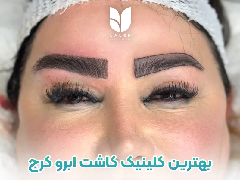 کاشت ابرو کرج