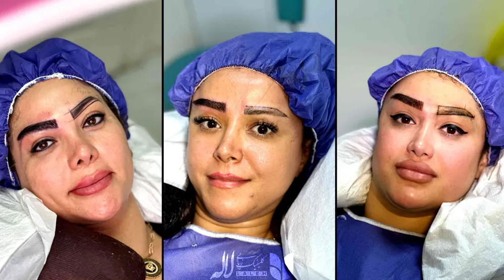 کاشت ابرو در کرج