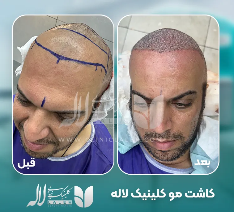 کاشت مو لاله