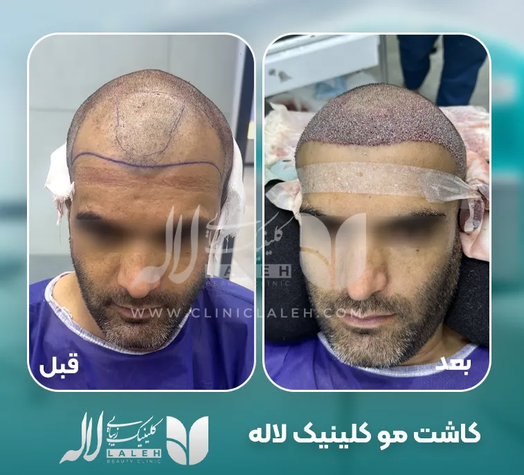 عکس قبل بعد کاشت مو