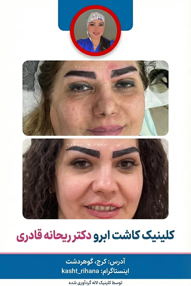 کاشت ابرو دکتر ریحانه قادری