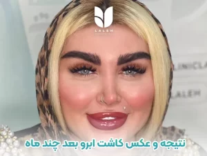 نتیجه کاشت ابرو + عکس کاشت ابرو بعد چند ماه