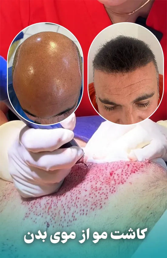نتیجه کاشت مو از موی بدن