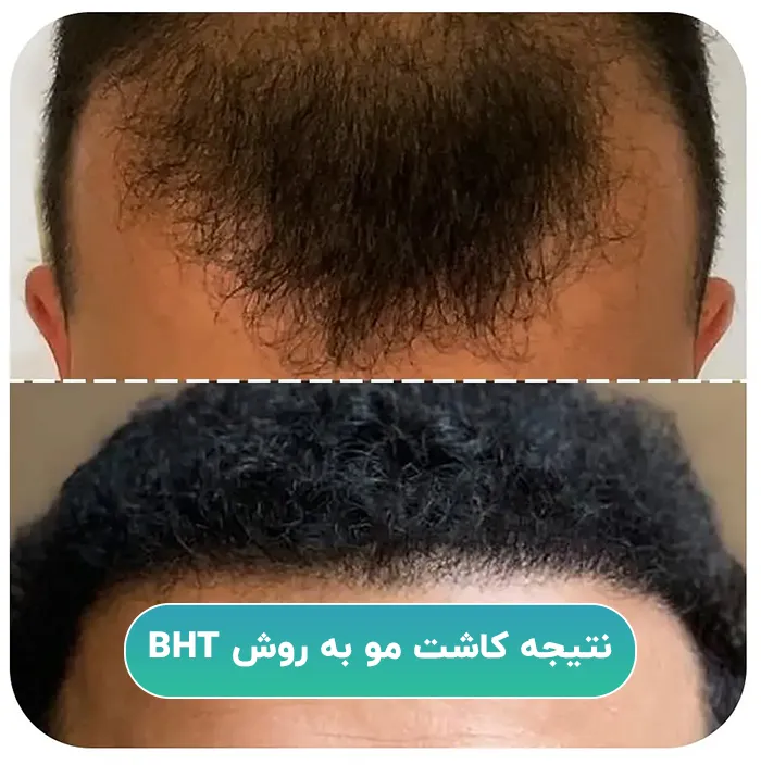 نتیجه کاشت مو BHT