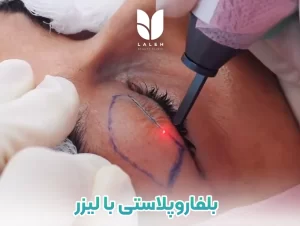 بلفاروپلاستی با لیزر