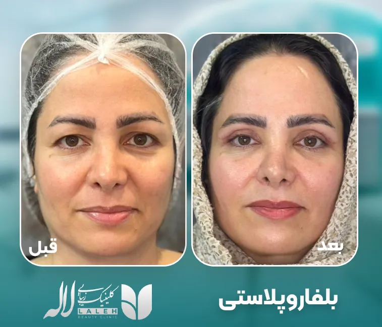 بلفاروپلاستی